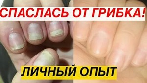 Грибки ногтей лечение в народной медицине