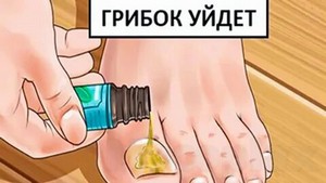 Спирт лечение грибка на ногтях ног