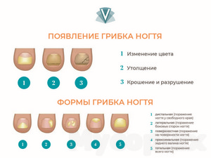 Лечение грибка на теле красные пятна