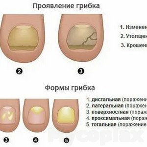 Схемы лечения грибка ногтей отзывы