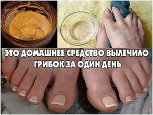 Грибок детей лечение