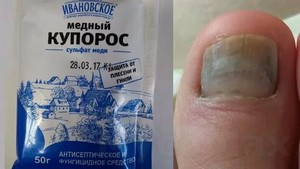 Лазерное лечение грибка ногтя красноярск