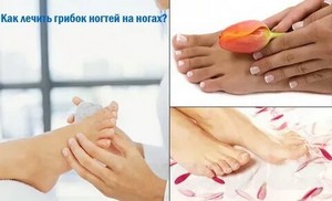 Лазерное лечение грибка ногтей тверь