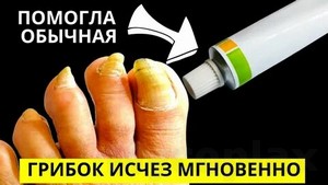 Народные рецепты лечения грибка на ногтях рук