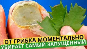 Капли для лечения грибка ногтя на ногах