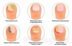 Лечение грибка ногтей снятием ногтях