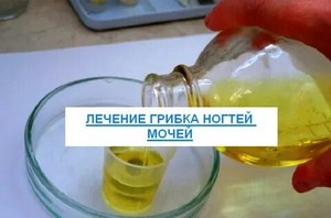 Лечение грибка на ступнях