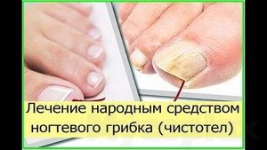 Лечение грибка ногтей дешево и эффективно