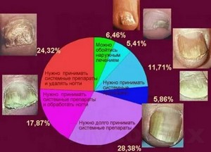 Лечение грибка ногтей врач отзывы