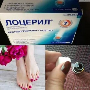 Лечение зеленкой грибка ногтей