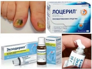 Лечение грибка ногтей медицина