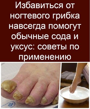 Народные средства лечения ногтевого грибка