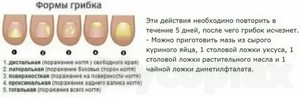 Грибок в ушах у людей лечение препараты недорогие но эффективные цена