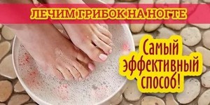 Грибок на теле народное лечение