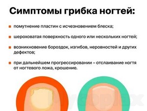 Лечение уксусом грибка ногтя народными средствами