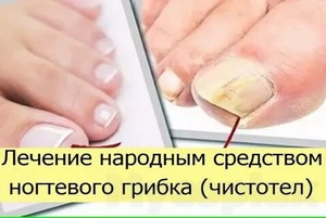 Эффективный препарат для лечения грибка ногтей на ногах отзывы