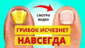 Лечение грибка мази и таблетки