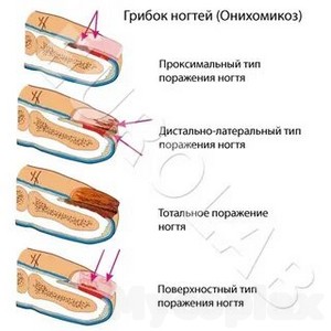 Лечение грибка ногтя изнутри