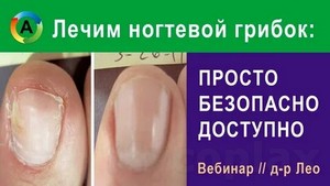 Отзывы лечение грибка цитросепт