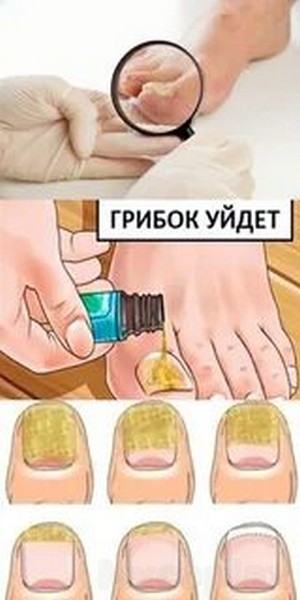 Паховый грибок эффективное лечение