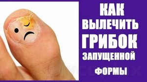 Грибок ногтя лечение уксусом отзывы