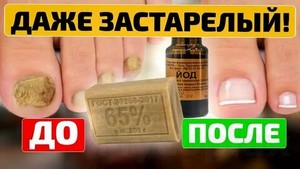 Препарат лечение грибка ногтей