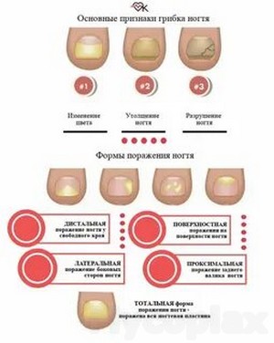 Лечение грибка ногтя народными средствами