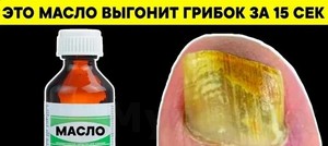 Мицелий грибка на ногтях лечение