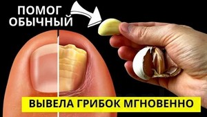 Лечение грибка ногтей мылом и содой