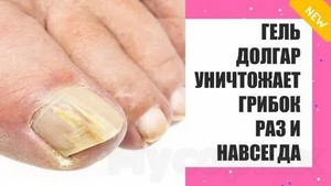 Грибок у детей симптомы и лечение