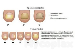 Лечение лазером грибка ногтя в омске цена