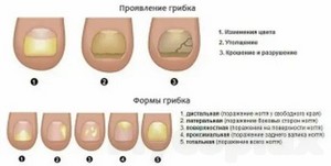 Лечение грибка паховой области