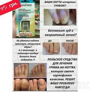 Грибок языка фото симптомы и лечение