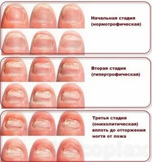 Клотримазол капли инструкция по применению для лечения грибка